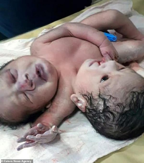 Ребенок с двумя головами и тремя руками родился в Индии 