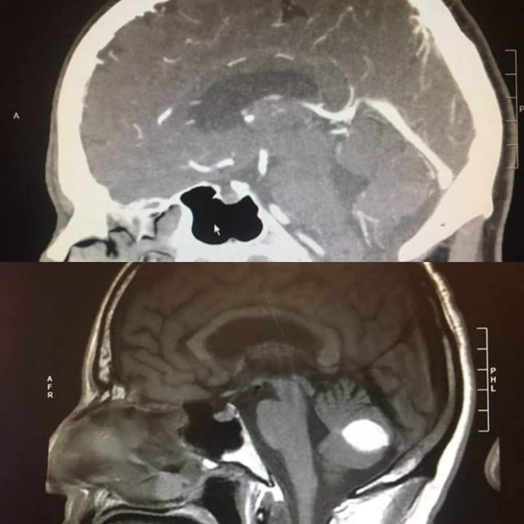 Снимки Пола Вуда, на которых видно, что опухоль мозга исчезла