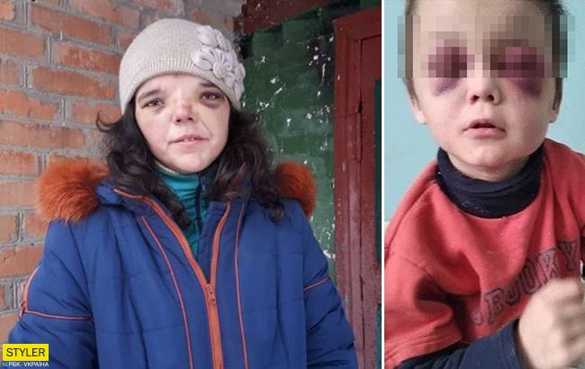 Избитый под Винницей ребенок. Коллаж РБК-Украина