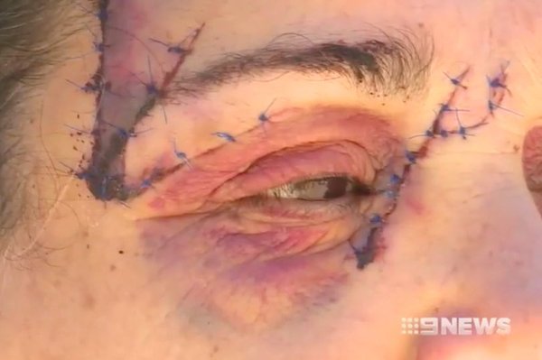 Кенгуру искалечил женщину 