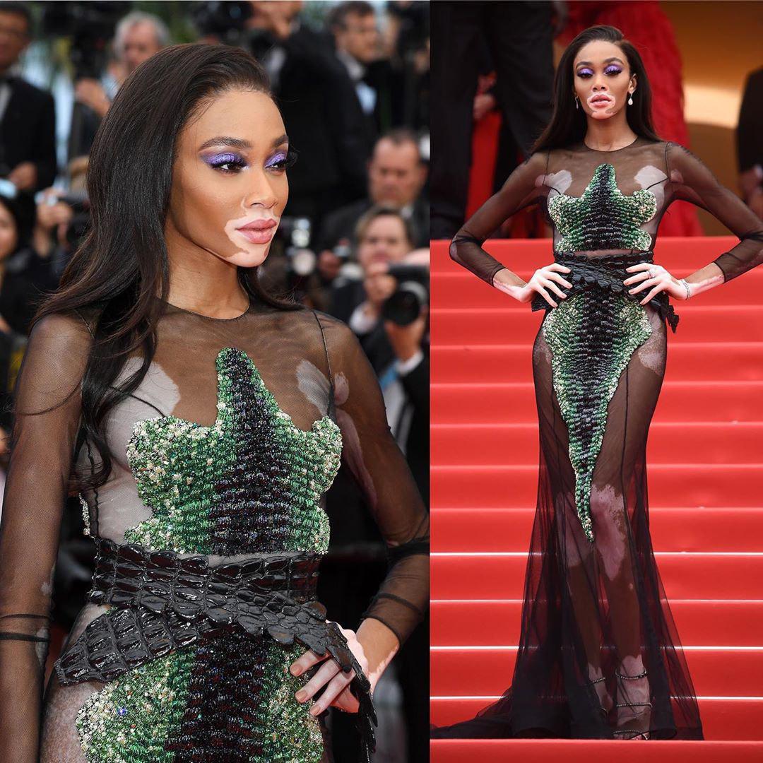 Винни Харлоу с редкой болезнью кожи