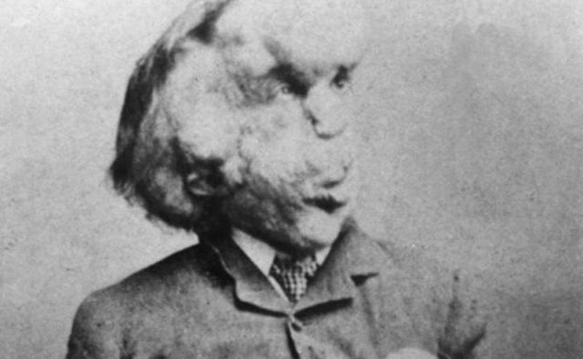 Джозеф Меррик 