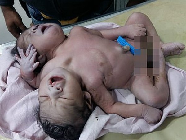 Ребенок с двумя головами 