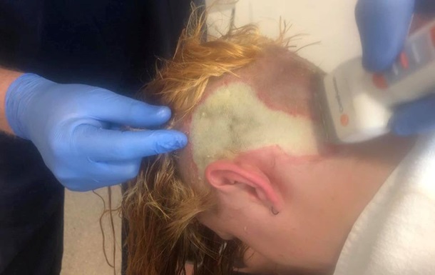 Девушка покрасила волосы и осталась с ожогами головы 