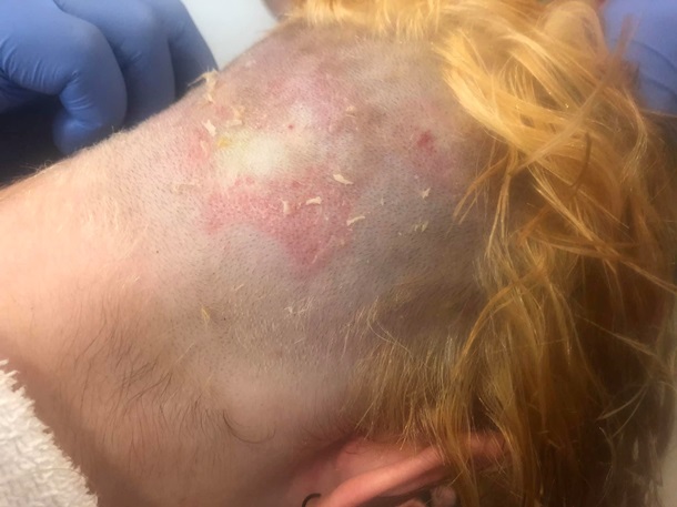 Девушка сожгла себе голову