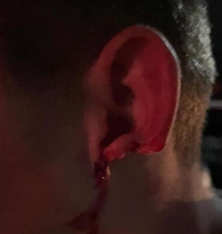 На Закарпатье парню откусили ухо на дискотеке