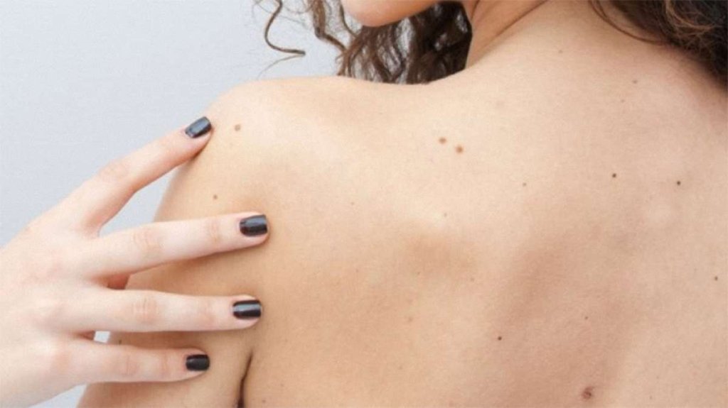 Что означают родинки на теле