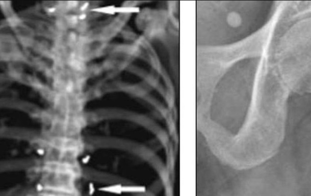 Рентген запечатлел иглы в позвоночнике. Фото: BMJ Case Reports