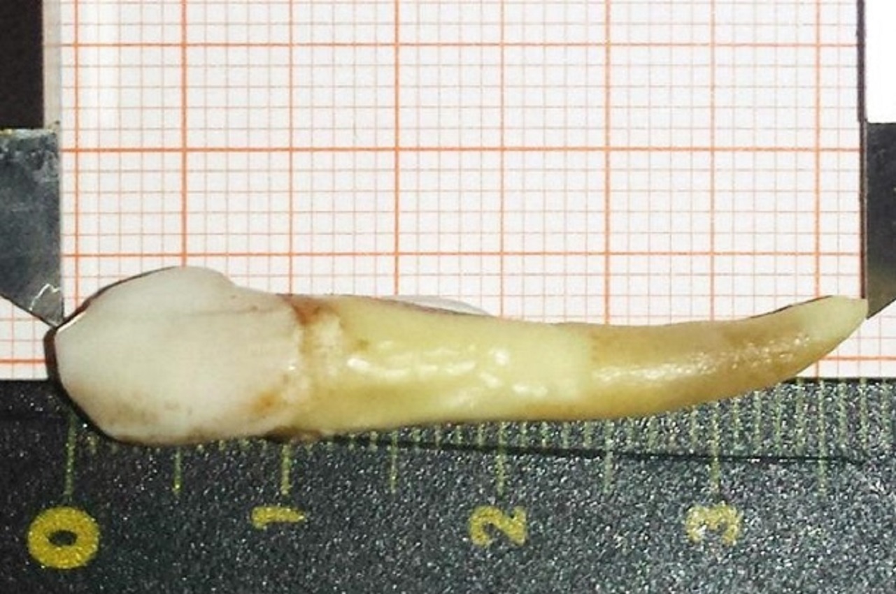 Пациент лишился рекордного по размерам зуба