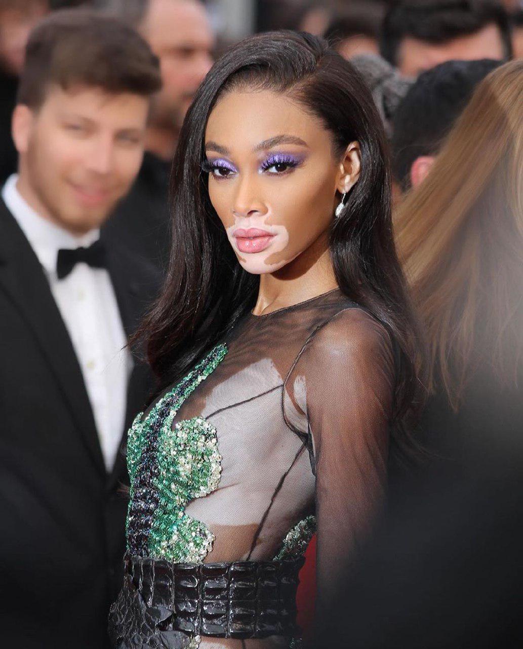 Винни Харлоу с редкой болезнью кожи