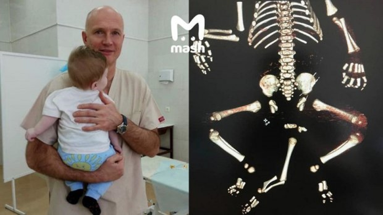 Московские врачи сделали очередную операцию малышу, родившемуся с тремя ногами