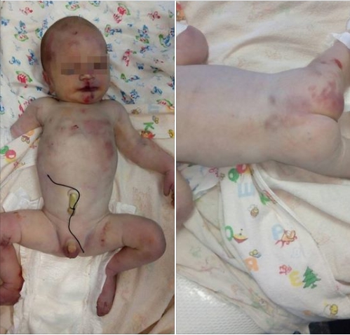 Новорожденного избили и подбросили к порогу больницы