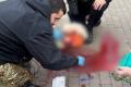 Бігла спускатися в метро: жінку з уламком в голові ушпиталили в тяжкому стані у Києві (фото, відео)
