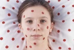 Эпидемия кори в Донецке. Начало