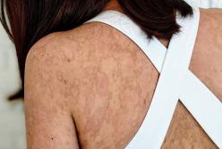 Трагическая история французской красавицы, которую изуродовала аллергия на пенициллин 