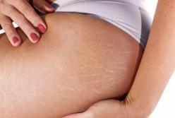 Как убрать растяжки: правда и мифы 