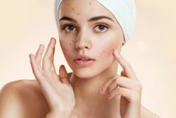 Как избавить кожу от прыщей, когда косметика не помогает