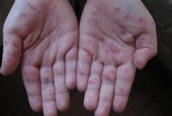 Что нужно знать о вирусе Коксаки: симптомы и как можно себя уберечь 