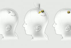 Имплантация чипов в мозг: неозвученные возможности Neuralink