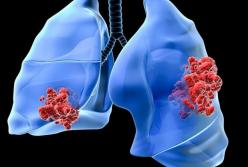 Врачи назвали симптомы рака легких