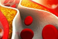 Медики назвали внешние признаки повышенного холестерина