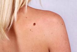 Медики назвали причины развития рака кожи
