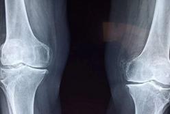 Медики выяснили, как стресс разрушает кости 