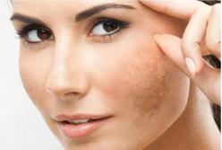 Медики назвали средство, которое поможет справится с прыщами и пигментацией 