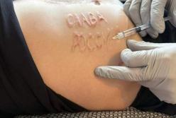 Лікарі почали видаляти з тіла військового напис "Слава России", який йому зробили у полоні (фото)