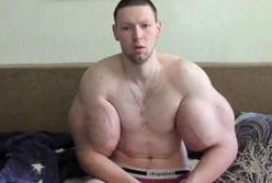 Хирурги удалили у "Руки-базуки" килограммы вазелина из бицепсов (фото)