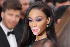 Знаменитая модель с редкой болезнью кожи впечатлила общество на кинофестивале в Каннах (фото)