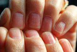 Желтые ногти, белые пятна и другие изменения ногтей, которые могут быть опасными 