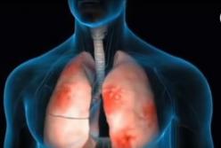 Пневмония. Главные симптомы воспаления легких