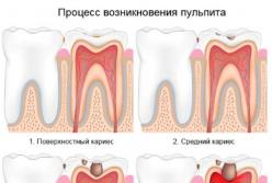 Кариес и другие: 5 самых распространенных зубных болезней