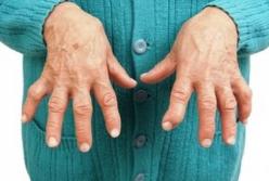 Медики назвали первые симптомы артрита