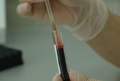 Назван неочевидный признак рака крови