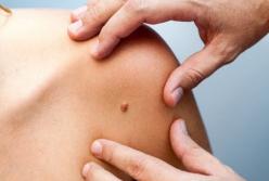 Медики рассказали, как самостоятельно обнаружить меланому