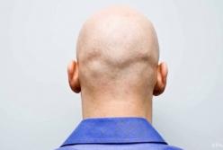 Ученые нашли способ избавиться от облысения за две недели