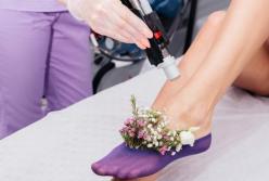 Основне, що потрібно знати про видалення волосся лазером