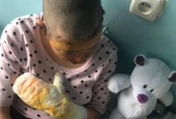 В Черновцах пьяный отец поджег 16-летнюю дочь и едва не угробил ее