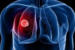 Рак легких: ученые выявили новые признаки смертельной болезни
