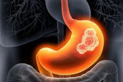 Рак желудка: вздутие живота и другие предупреждающие знаки