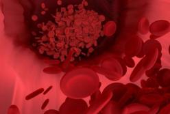 Медики назвали симптомы смертельно опасного тромба