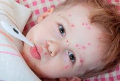 В Україні зафіксували спалах захворюваності на кір