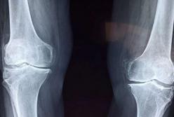 Названы ранние признаки остеопороза, которые нельзя игнорировать 