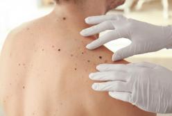 Ученые рассказали о значение родинок на теле у мужчин и женщин 