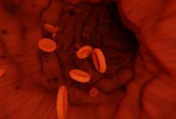 Медики объяснили, как распознать образовавшийся в венах тромб 