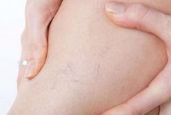 Названы пять признаков, свидетельствующих о наличии тромбов