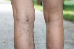 Медики перечислили симптомы варикоза