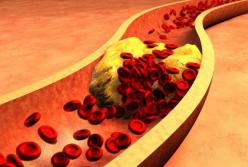 Медики рассказали, от каких лекарств повышается холестерин